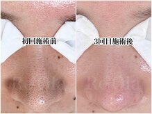 リオラ 大分(Re’Ola)の雰囲気（拡大鏡を使って丁寧に除去！毛穴エクストラクション認定サロン）
