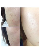 ニコ ウィズ(Nico with)/シミケア