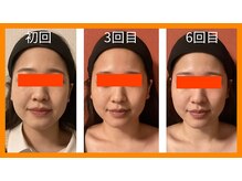 ロイヤリティ(ROYALTY)/回数を重ねるとお顔はこう変わる