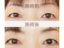 ハピネス(Happiness)/受賞の技で瞼とまつ毛が上がる