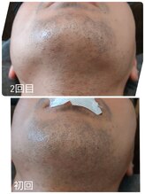 エムブルーム(m-bloom)/メンズひげ脱毛