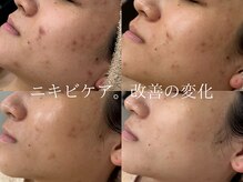 ラシュール(Rassure)/ハーブピーリングでニキビケア