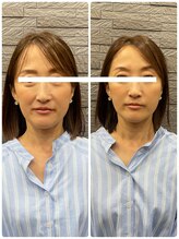 長寿鍼灸院 長寿整骨院/美容鍼50本の効果★ハリ・ツヤ