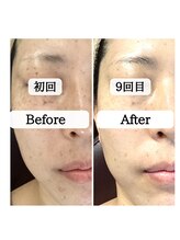 ル ボヌール 伊那店(le bonheur)/目周り、まぶたのシミも◎