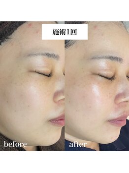 リニューサロン 本院(renew salon)/くすみ・トーンアップ