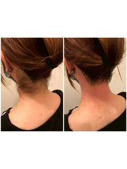 パーツ脱毛のできるサロン