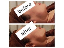 フェイスラインもたつきや二重あごが気になってきた方におススメ