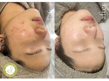 【ホワイトニング×ハーブピーリング】毛穴/肌質改善/SALON el【2/1 OPEN(予定)】の雰囲気(毛穴/くすみ/陶器肌/ホワイトニング/ハーブピーリング/水光肌)