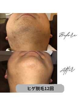 プレジール 大野城店(plaisir)/ヒゲ脱毛