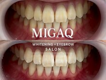 ミガク 京都四条大宮店(MIGAQ)/京都/四条大宮/ホワイトニング