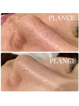 プランス 渋谷(PLANCE)/毛穴大掃除!渋谷 フェイシャル