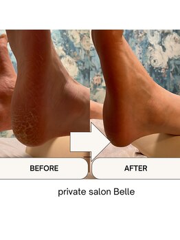 ベル(Belle)/角質フットケアビフォーアフター