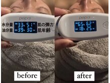 ビー ブルーム(B BLOOM)/【ハーブピーリング】数値の変化