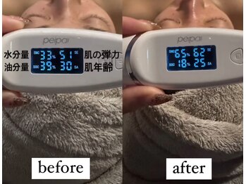 ビー ブルーム(B BLOOM)/【ハーブピーリング】数値の変化