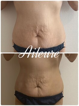 エルール トータルビューティ(Aileure total beauty)/インディバ痩身