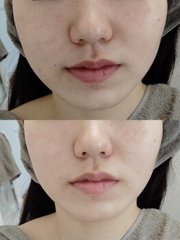 ビーユー(Be.you)/毛穴洗浄&小顔