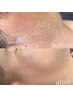 【 men’s 脱毛 】ヒゲ脱毛＋ヘッドマッサージ　お得な３回コース♪