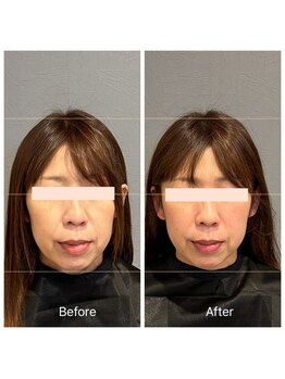 プライミー(PRIMY)/お顔の歪み