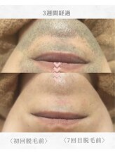 エール(AEELE)/■ヒゲ脱毛■