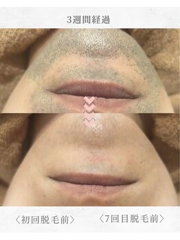 エール(AEELE)/■ヒゲ脱毛■