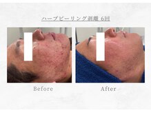 エヴァーグレース 三河安城店(EVER GRACE)/【肌管理】ハーブピーリング剥離