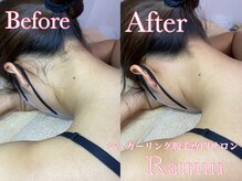 ラナン(Ranun)/どんな脱毛よりもスベスベになる