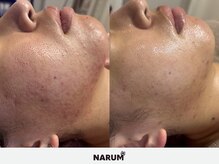 ナルムフェイシャル 代々木(NARUM facial)/【肌質改善】水光ピーリング