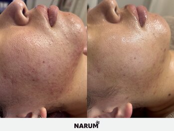 ナルムフェイシャル 代々木(NARUM facial)/【肌質改善】水光ピーリング