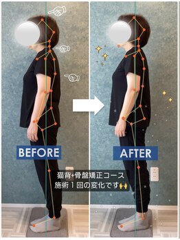 ラクリエ 姫路駅前院(La Creer)/施術ビフォーアフター/反り腰