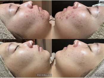 フィール(feel)/ハーブピーリング剥離なしニキビ