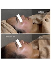 サロン グリッター 新宿(Salon GLITTER)/【肌質改善】ビフォーアフター