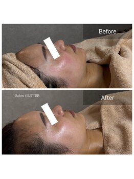 サロン グリッター 新宿(Salon GLITTER)/【肌質改善】ビフォーアフター