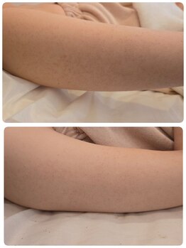 サロンド シェリー(Salon de Cherie)/腕 ハーブピーリング