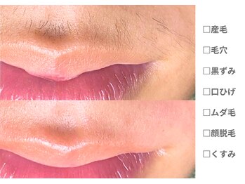 ピュアノア 三木店/脱毛　三木/小野/西脇/加東/加西