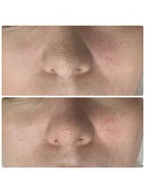 ラウレア(Laule'a)/津山｜毛穴スッキリケア