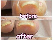 ラピス(Lapis)/巻き爪ケア！！