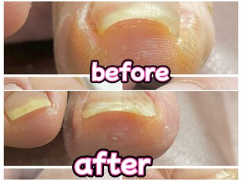 ラピス(Lapis)/巻き爪ケア!!