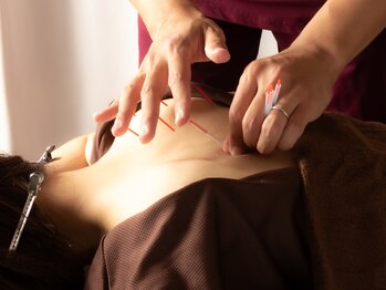 深谷接骨院/【部分鍼灸】今解決したい症状に