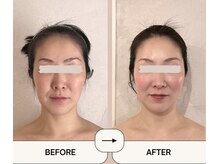 アメアラレ(amearare)/小顔コルギ 90分 3回施術