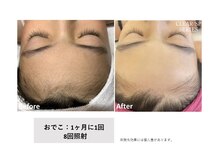 エクラ(eclat)/脱毛