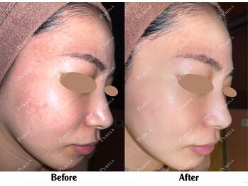 ピュアラ 心斎橋店/白玉ホワイトスノーピールで光肌