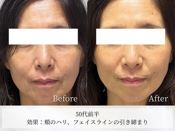 アストリエ グレース 相模大野(Astorie Grace)/1回でもリフトアップ♪