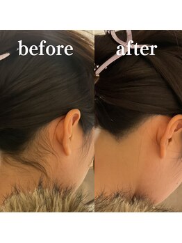 ミノア 大野城店(MINOA)/うなじ脱毛◆ビフォーアフター