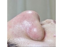 美プラス/《20代》最新毛穴洗浄