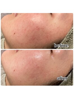 レピア つくば店(LEPIA)/花粉で荒れてしまったお肌