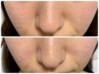 ナチュライズ(NatuRise)/毛穴ケア