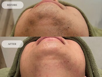 メンズプラス(MEN’S PLUS)/ヒゲ脱毛/ビフォーアフター写真