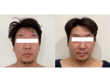 パラフューズ 札幌店 ブランジュ(PARAFUSE.)/脳洗浄before after