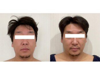 パラフューズ 札幌店 ブランジュ(PARAFUSE.)/脳洗浄before after