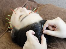 ソリーシェ鍼灸院(SORRISCE)/美容鍼灸もお任せください★